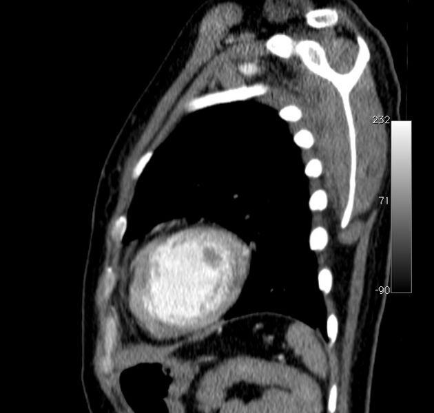 File:Aortic dissection - Stanford type A (Radiopaedia 29247-29659 C 3).jpg