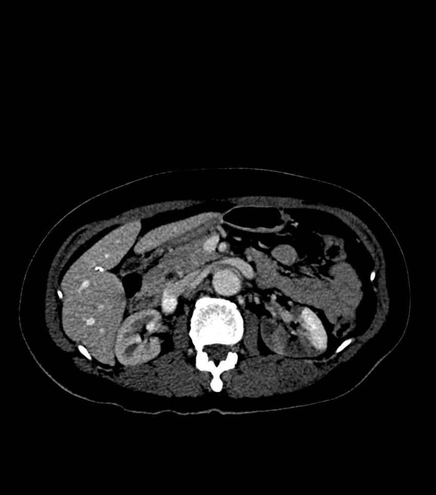 Aortic dissection with renal ischemia (Radiopaedia 76573-88338 B 34).jpg