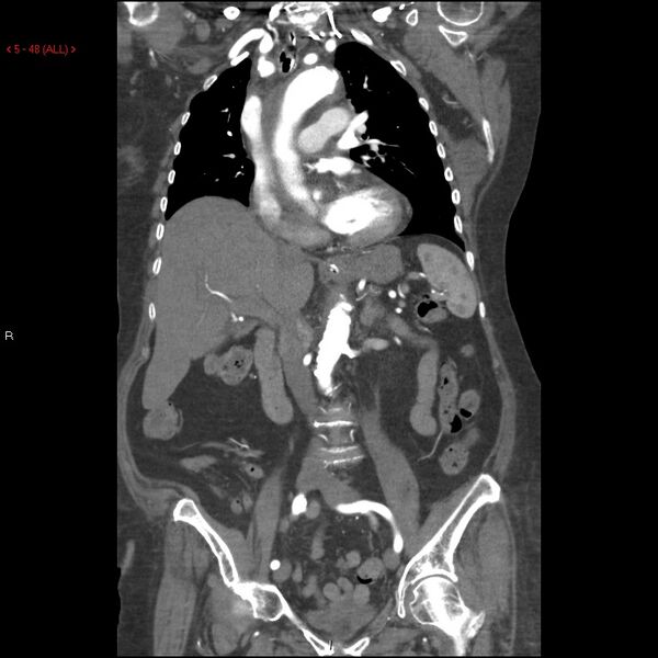 File:Aortic intramural hematoma (Radiopaedia 27746-28001 B 25).jpg
