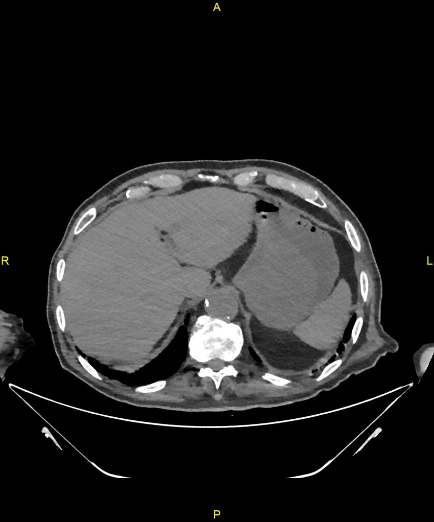 Aortoenteric fistula (Radiopaedia 84308-99603 Axial non-contrast 46).jpg