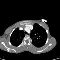 Aortopulmonary window, interrupted aortic arch and large PDA giving the descending aorta (Radiopaedia 35573-37074 B 20).jpg