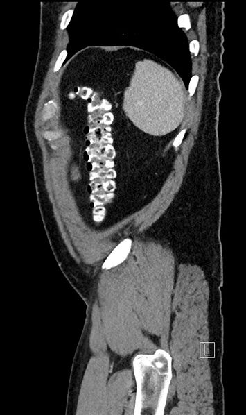 File:Appendiceal diverticulitis (Radiopaedia 61802-69816 C 18).jpg
