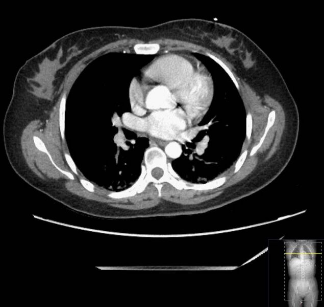 File:Appendicitis (CT angiogram) (Radiopaedia 154713-127660 Axial 199).jpg