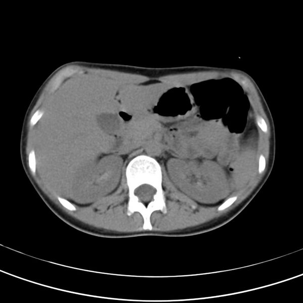 File:Appendicitis and incidental bicornuate uterus (Radiopaedia 22833-22853 Axial non-contrast 14).jpg