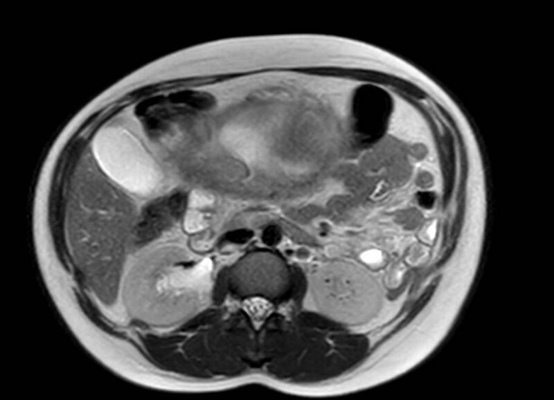 File:Appendicitis in gravida (MRI) (Radiopaedia 89433-106395 Axial T2 26).jpg