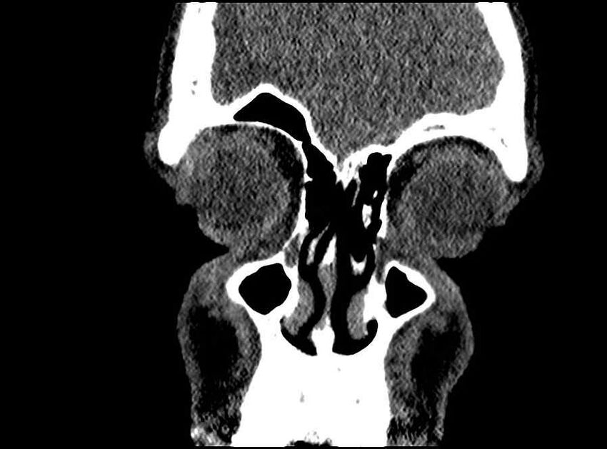 Arachnoid cyst- extremely large (Radiopaedia 68741-78450 Coronal bone window 64).jpg