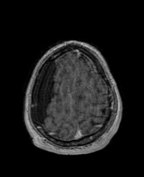 File:Arachnoid cyst- extremely large (Radiopaedia 68741-78451 Axial T1 C+ 69).jpg