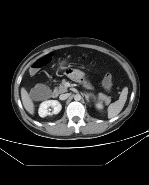 File:Arterial occlusive mesenteric ischemia (Radiopaedia 84641-100054 A 42).jpg