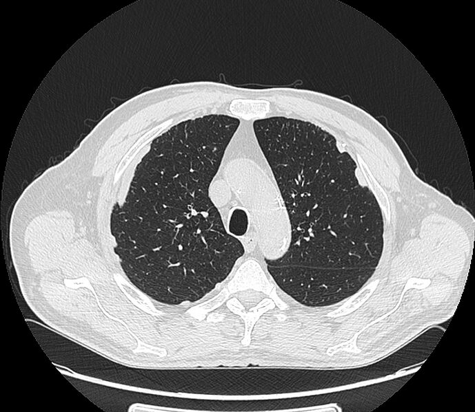 File:Asbestos pleural placques (Radiopaedia 57905-64872 Axial lung window 73).jpg