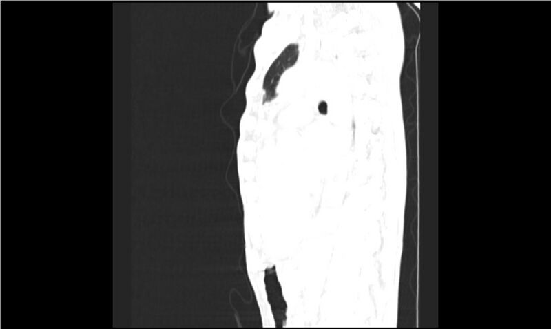 File:Aspergilloma (Radiopaedia 20788-20701 Sagittal lung window 9).jpg