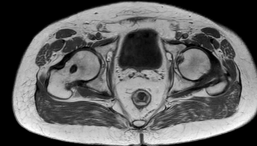 Atypical lipomatous tumor - thigh (Radiopaedia 68975-78734 Axial T1 92).jpg