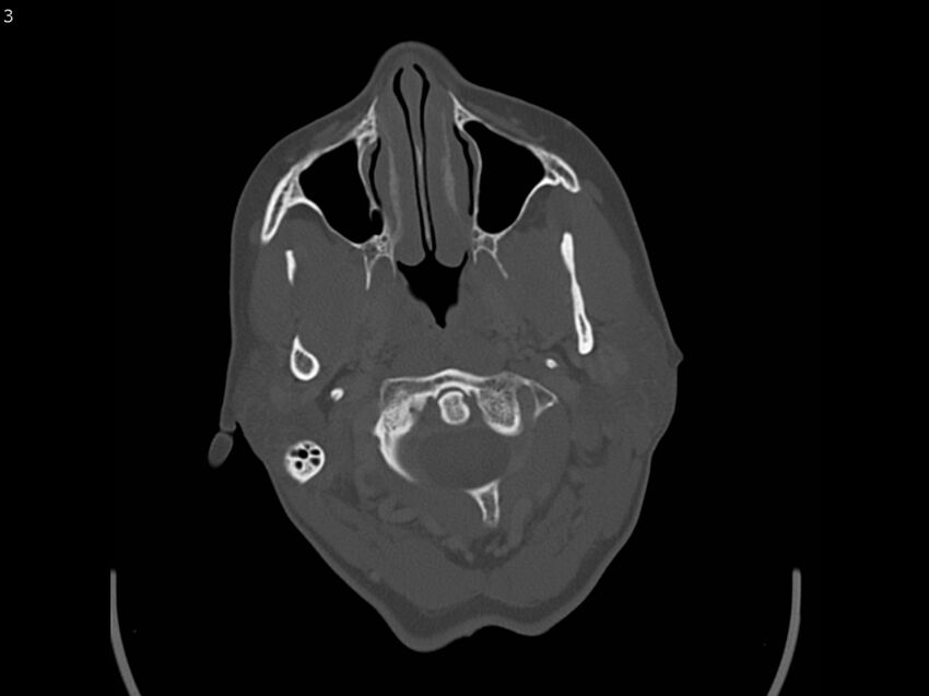 Atypical meningioma - intraosseous (Radiopaedia 64915-73867 Axial C+ bone window 3).jpg