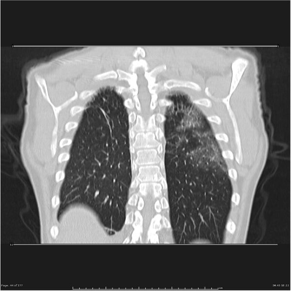 File:Atypical pneumonia - Q fever (Radiopaedia 21993-21989 C 37).jpg