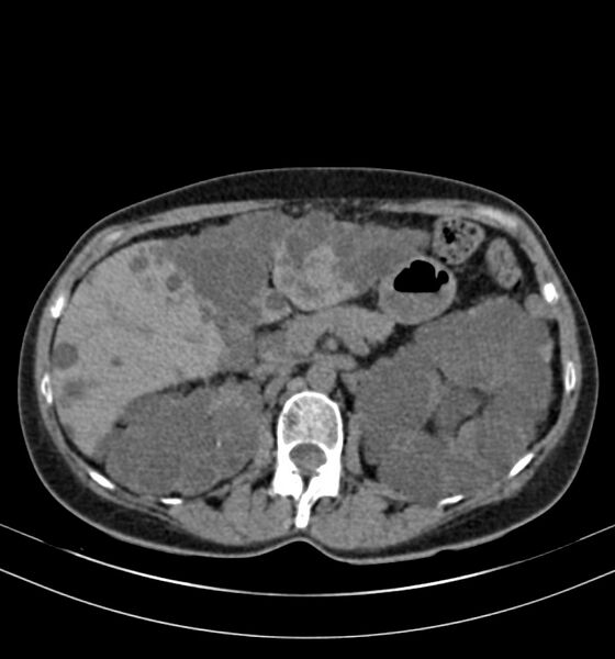 File:Autosomal dominant polycystic kidney disease (Radiopaedia 41918-44922 Axial non-contrast 10).jpg