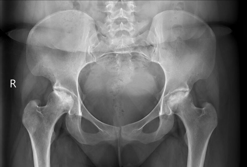File:Avascular necrosis - hip joint (Radiopaedia 66041).jpg