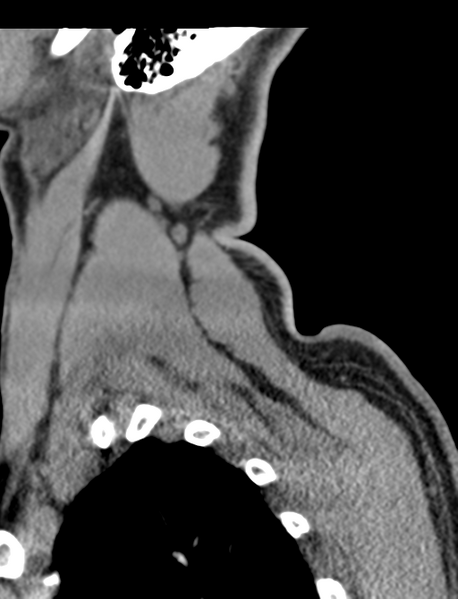 File:Axis peg fracture (type 3) and atlas lateral mass (type 4) fracture (Radiopaedia 37474-39324 D 71).png