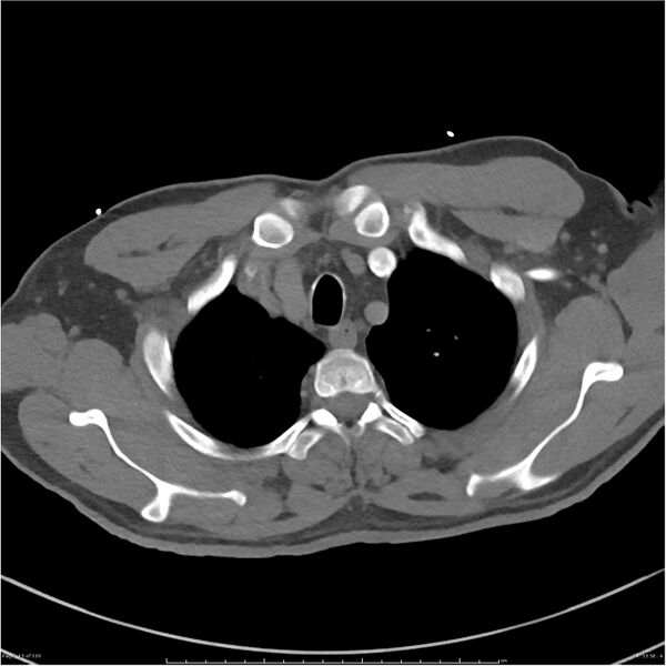 File:Azygos venous system anatomy (CT pulmonary angiography) (Radiopaedia 25928-26077 Axial C+ CTPA 13).jpg