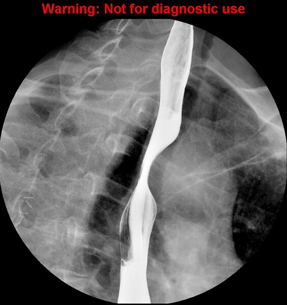 File:Barrett esophagus (Radiopaedia 44421-48075 A 5).jpg
