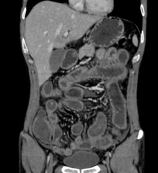 File:Behçet's disease- abdominal vasculitis (Radiopaedia 55955-62570 B 16).jpg