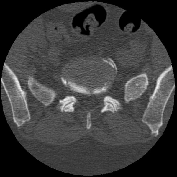 File:Bertolotti syndrome (Radiopaedia 24864-25128 Axial bone window 30).jpg