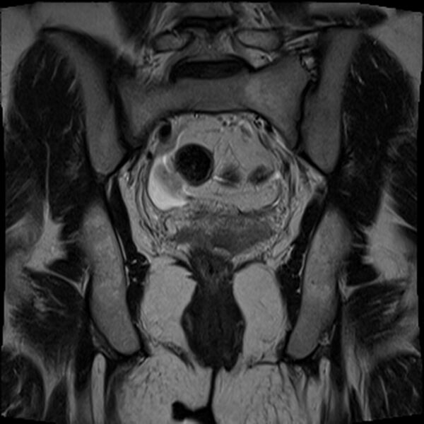 File:Bicornuate, unicollis uterus (Radiopaedia 79468-92593 Coronal T2 17).jpg