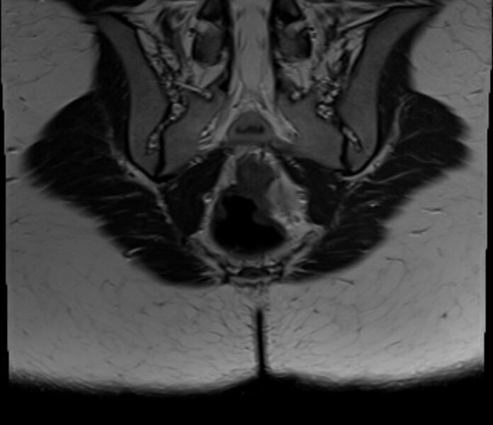 File:Bicornuate uterus (Radiopaedia 71214-81511 Coronal T2 2).jpg