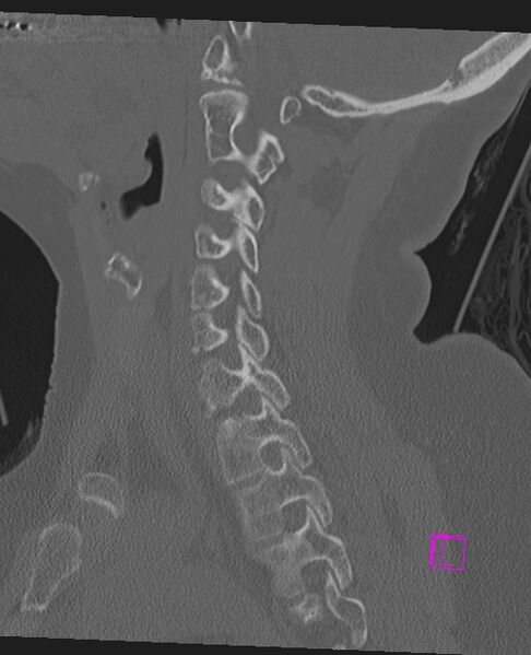 File:Bilateral atlanto-occipital assimilation (Radiopaedia 28350-28603 Sagittal bone window 32).jpg