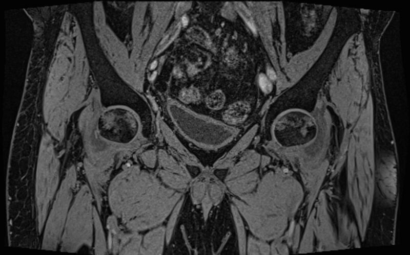 File:Bilateral avascular necrosis of femoral head (Radiopaedia 77116-89078 Coronal T2 we 61).jpg