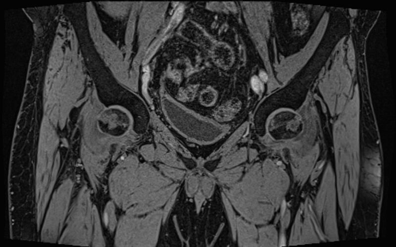 File:Bilateral avascular necrosis of femoral head (Radiopaedia 77116-89078 Coronal T2 we 66).jpg