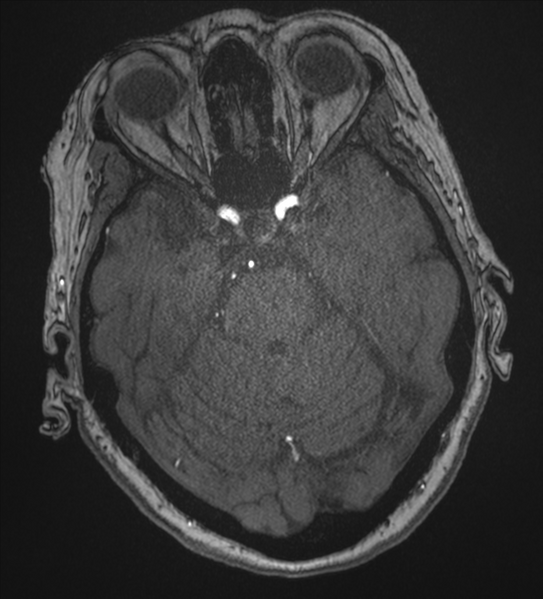 File:Bilateral fetal posterior communicating arteries (Radiopaedia 41286-44102 Axial MRA 64).png