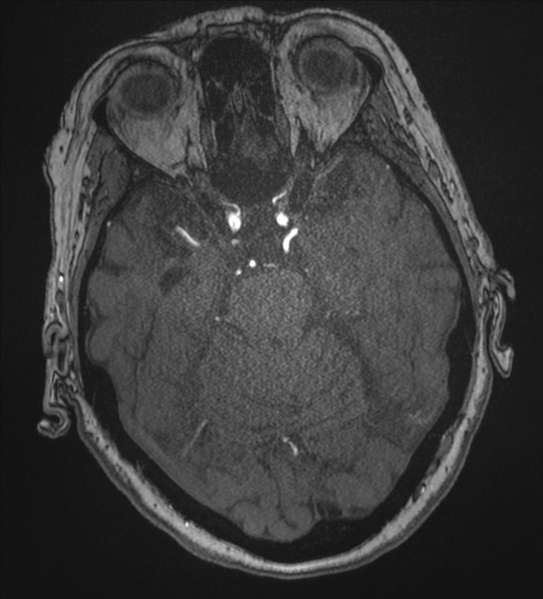 File:Bilateral fetal posterior communicating arteries (Radiopaedia 41286-44102 Axial MRA 69).png
