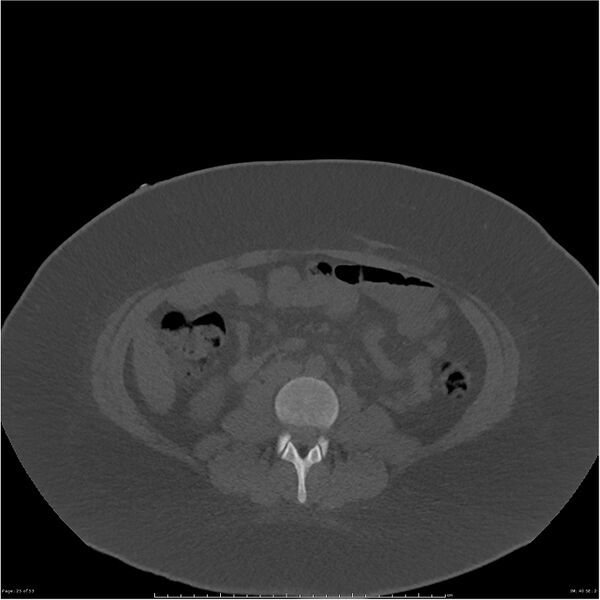 File:Bilateral lumbar ribs (Radiopaedia 25862-26010 bone window 25).jpg