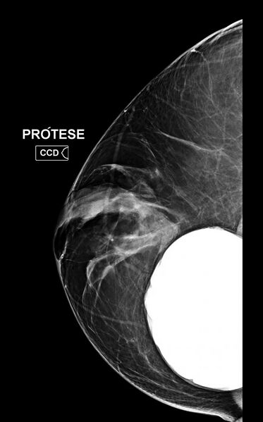 File:Bilateral mammoplasty (Radiopaedia 82984-97337 CC 1).jpg