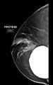 Bilateral mammoplasty (Radiopaedia 82984-97337 CC 1).jpg