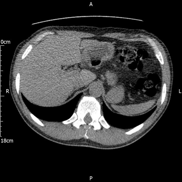 File:Bilateral medullary nephrocalcinosis with ureteric calculi (Radiopaedia 71269-81569 Axial non-contrast 19).jpg