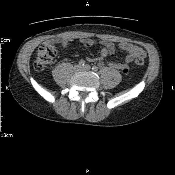File:Bilateral medullary nephrocalcinosis with ureteric calculi (Radiopaedia 71269-81569 Axial non-contrast 83).jpg