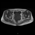 Bilateral ovarian fibroma (Radiopaedia 44568-48293 Axial T1 18).jpg