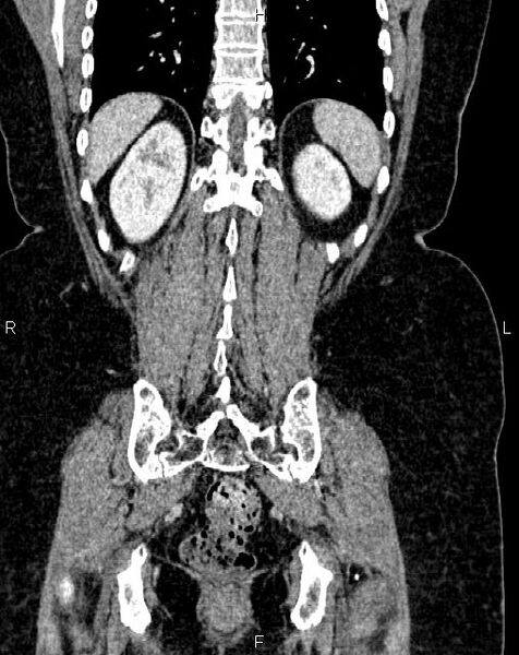 File:Bilateral ovarian serous cystadenocarcinoma (Radiopaedia 86062-101989 D 43).jpg