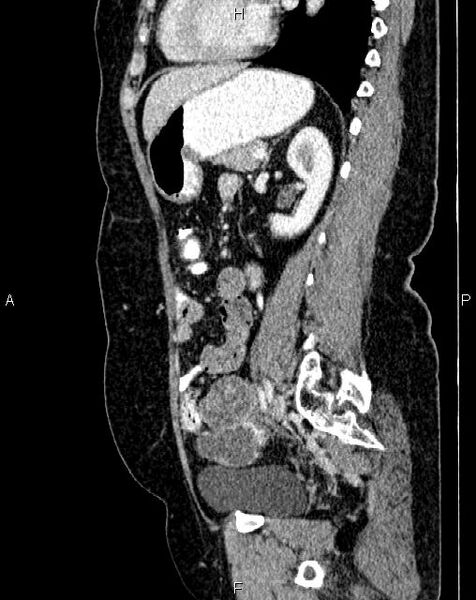 File:Bilateral ovarian serous cystadenocarcinoma (Radiopaedia 86062-101989 E 55).jpg