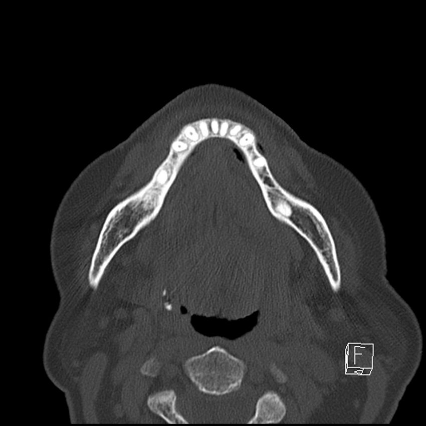 Bilateral palatine tonsilloliths on OPG and CT (Radiopaedia 75167-86247 Axial bone window 47).jpg