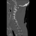 Bilateral perched facets with cord injury (Radiopaedia 45587-49713 Sagittal bone window 18).jpg