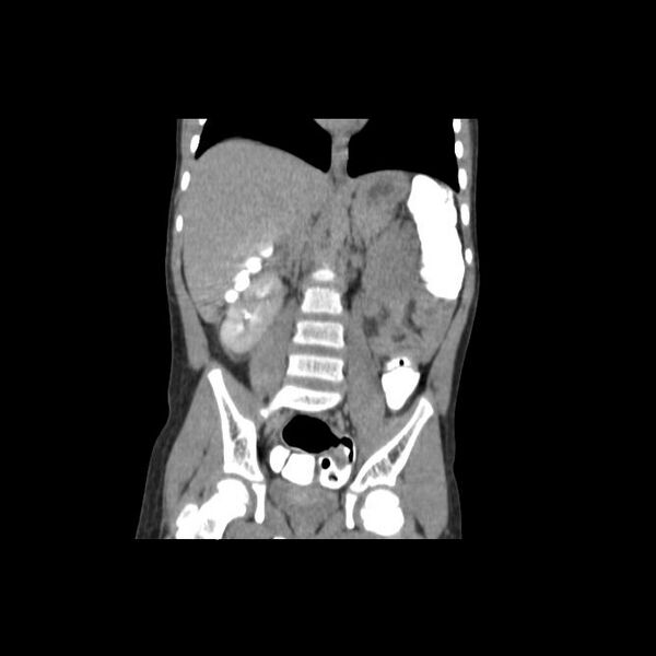 File:Bilateral renal malrotation (Radiopaedia 30901-31606 Coronal C+ delayed 3).jpg