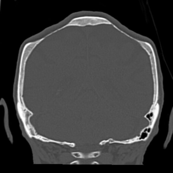 File:Biparietal osteodystrophy (Radiopaedia 46109-50463 Coronal bone window 76).jpg