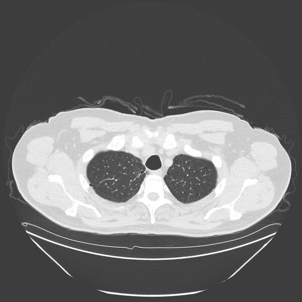 File:Birt-Hogg-Dubé syndrome (Radiopaedia 52578-58491 Axial lung window 9).jpg