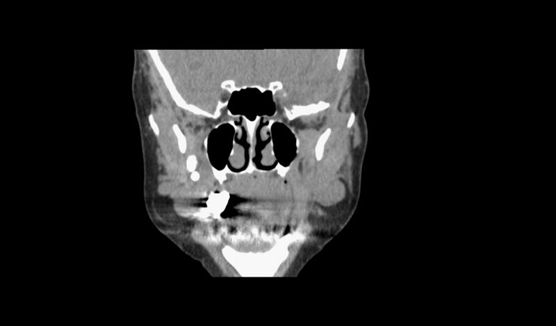 File:Blue rubber bleb nevus syndrome (Radiopaedia 51171-56823 Coronal non-contrast 18).jpg