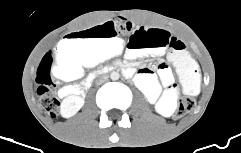 File:Blunt injury to the small bowel (Radiopaedia 74953-85987 A 75).jpg