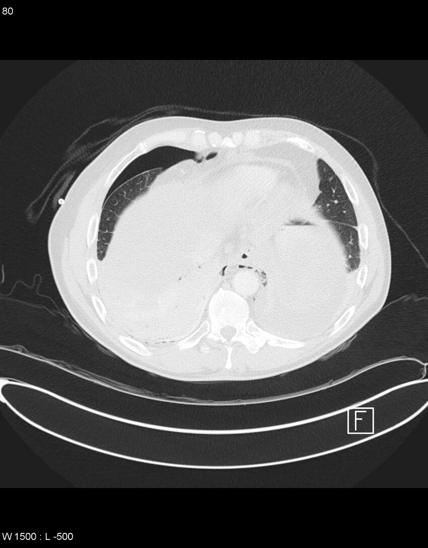 Boerhaave syndrome with tension pneumothorax (Radiopaedia 56794-63605 Axial lung window 39).jpg