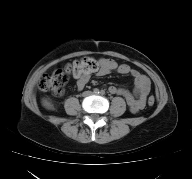File:Bosniak renal cyst - type IV (Radiopaedia 22929-22953 Axial non-contrast 36).jpg
