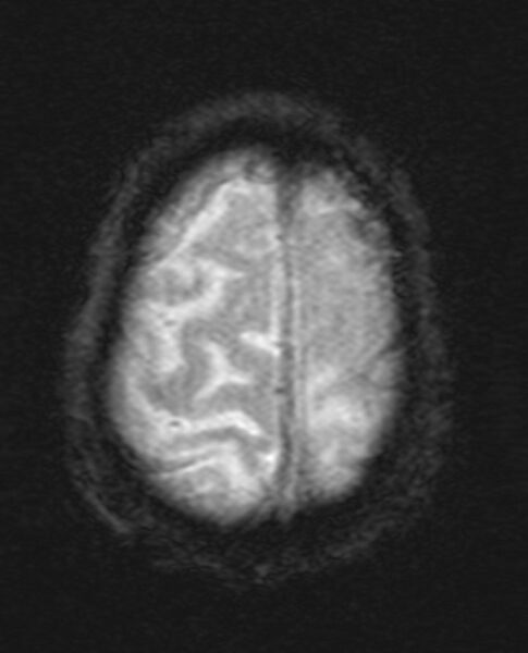 File:Brain abscess with dual rim sign (Radiopaedia 87566-103938 Axial SWI 20).jpg
