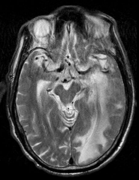 File:Brain abscess with dual rim sign (Radiopaedia 87566-103938 Axial T2 9).jpg